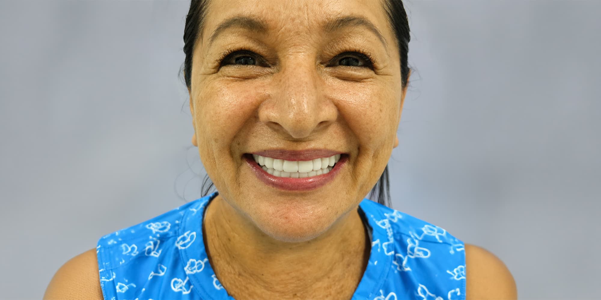 Diseño de sonrisa con 20 carillas