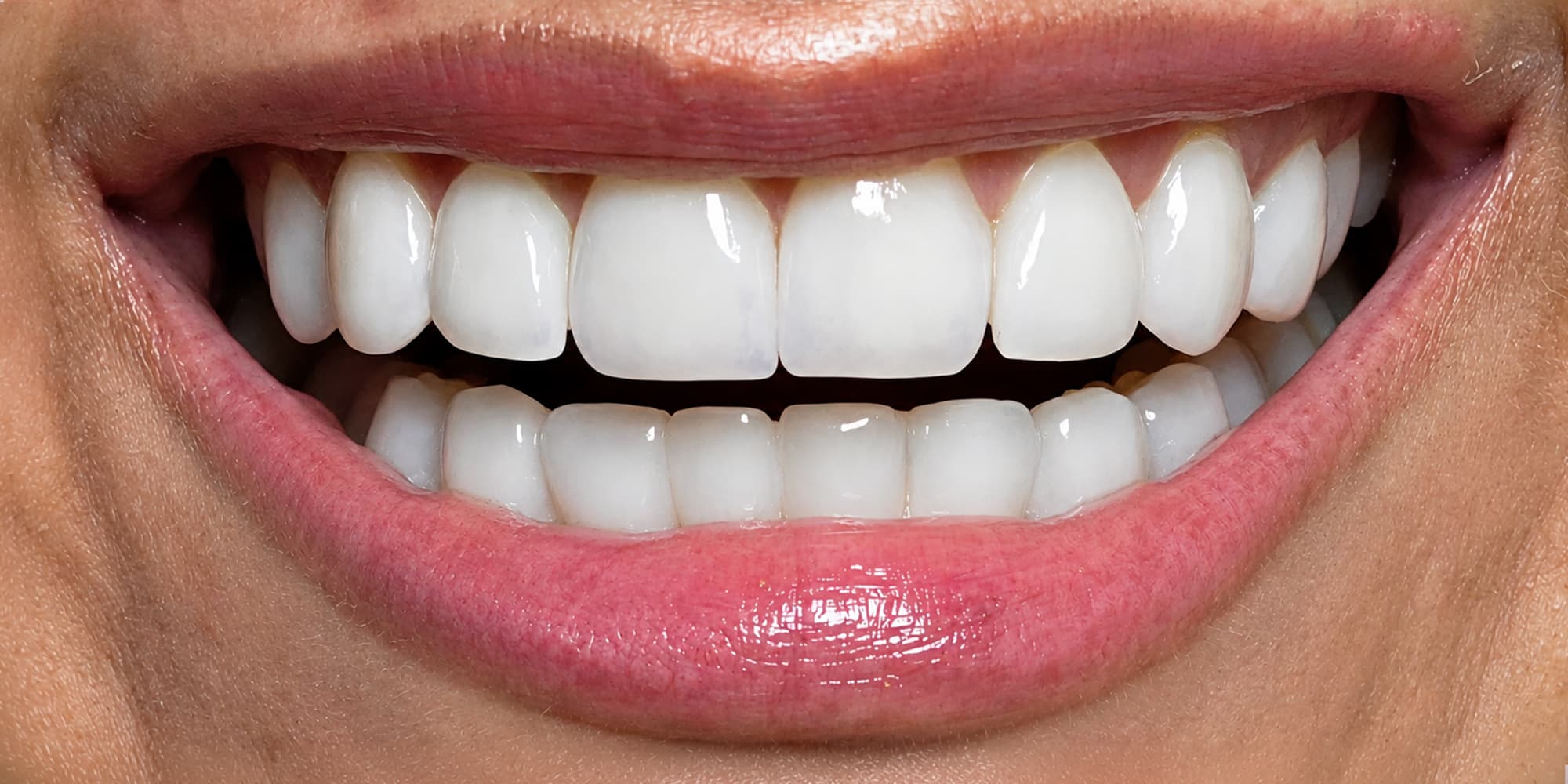 Diseño de sonrisa con 16 carillas