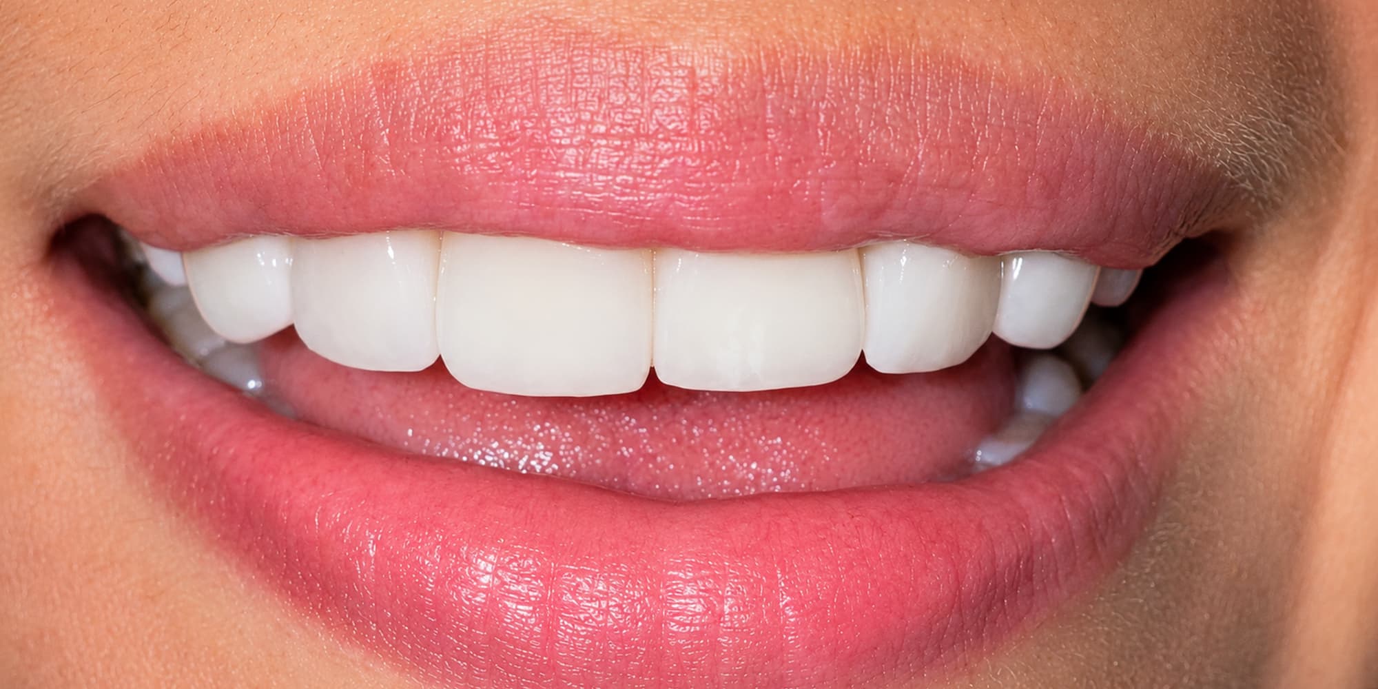 Gingivectomía y rehabilitación superior