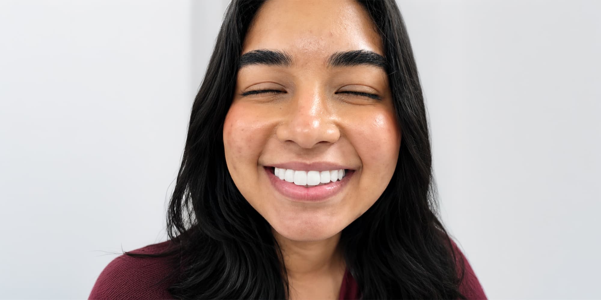 Diseño de sonrisa superior