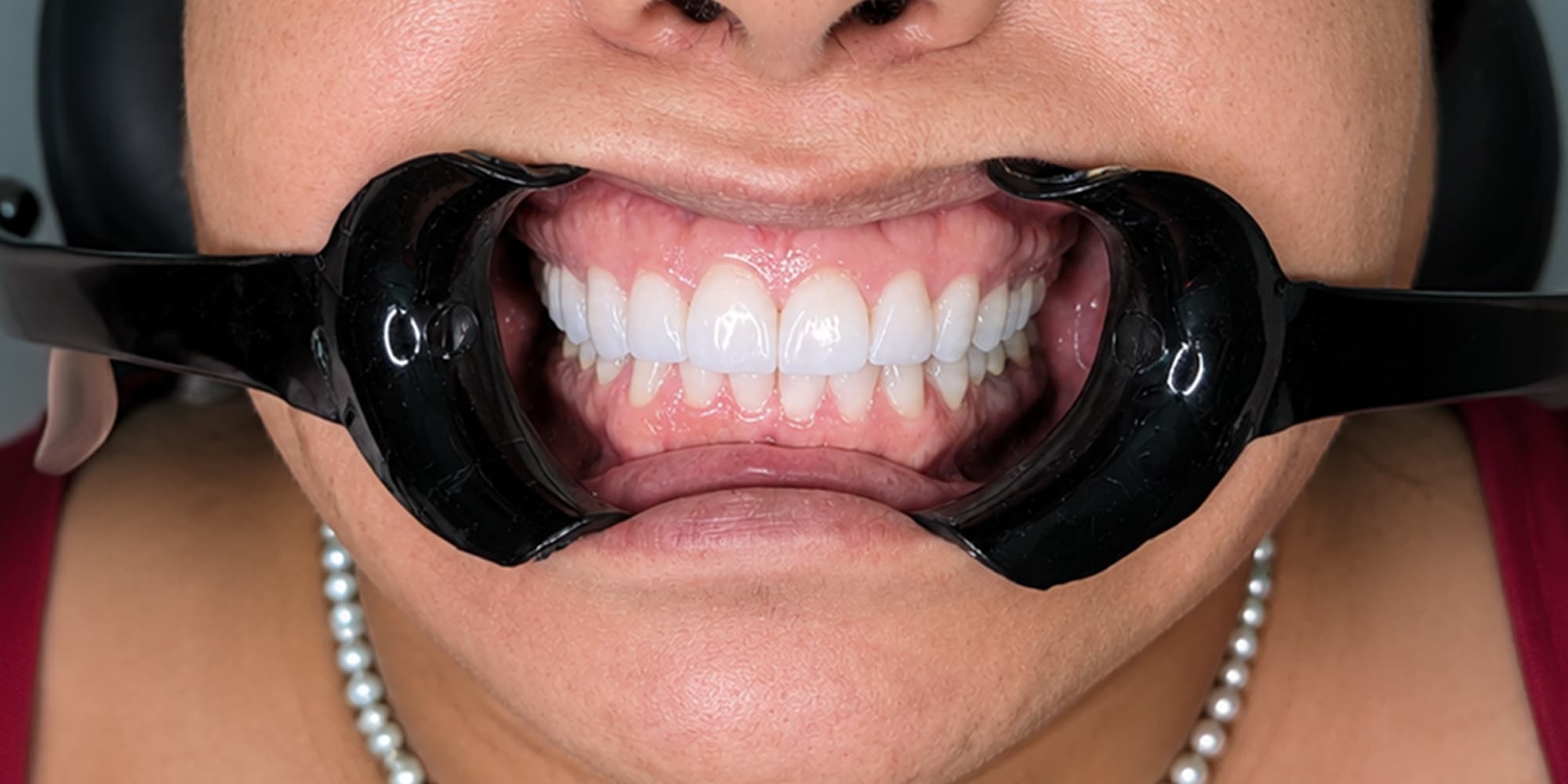 Diseño de sonrisa superior