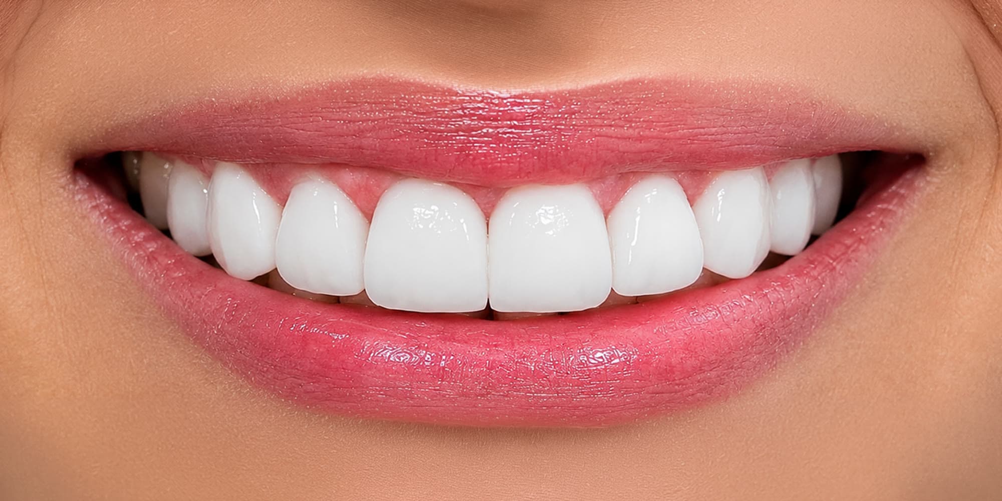 Diseño de sonrisa con 10 lentes cerámicos