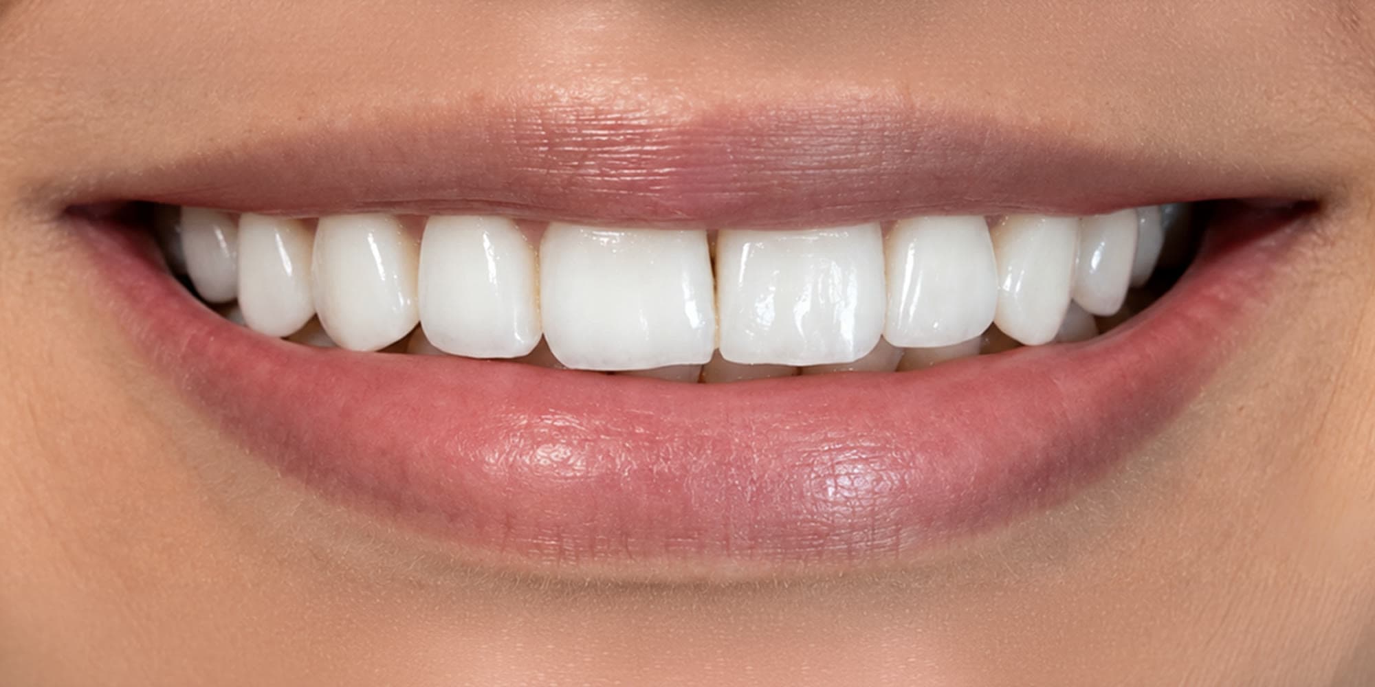 Diseño de sonrisa superior