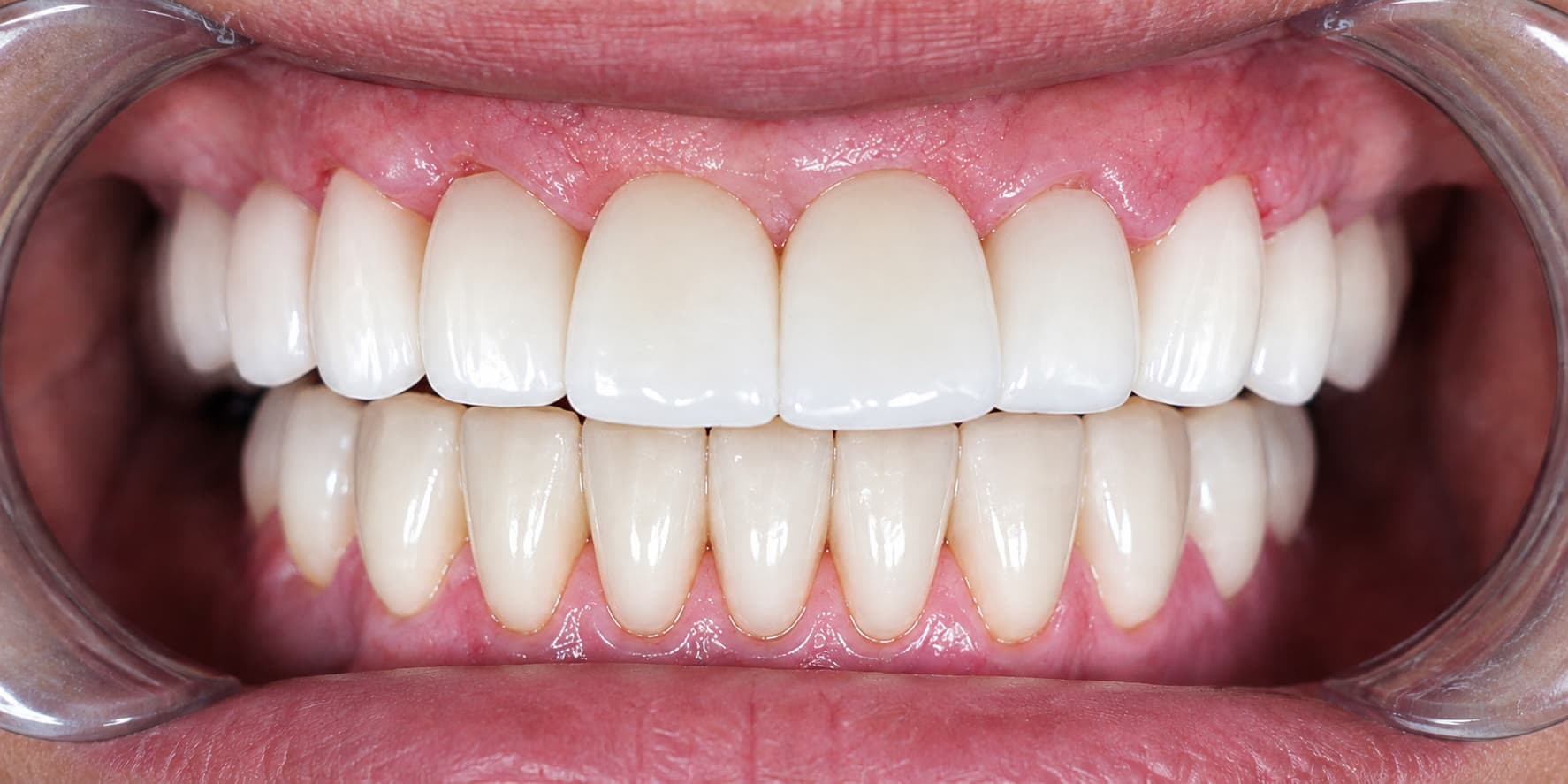 Rehabilitación oral completa sobre 4 implantes